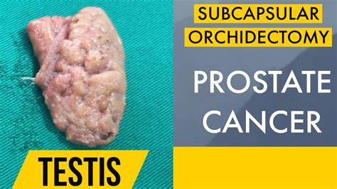 orchiectomy in prostate cancer